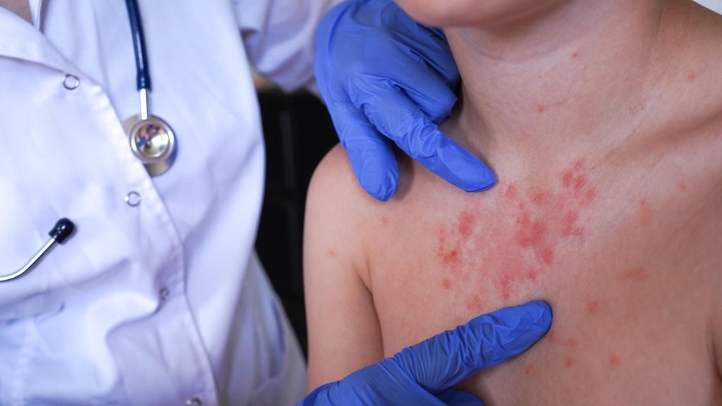 Minnesota's 80 measles cases this year are the most since 1990, health officials say — Maplewood Health news