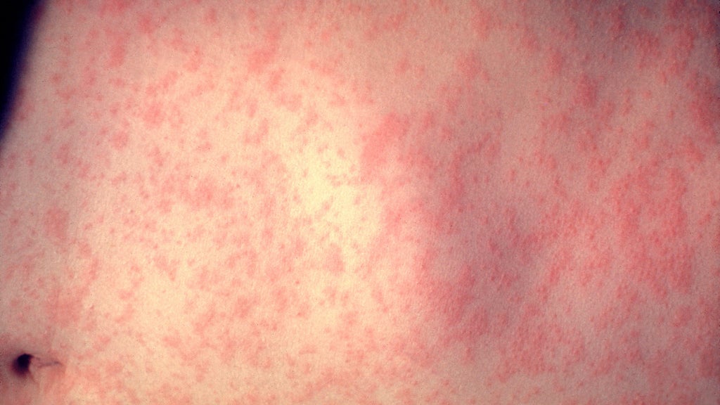 25 cases of measles identified in central, southeastern Minnesota, MDH says — WCCO / CBS Minnesota, Maplewood Health news